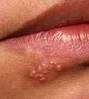 herpes labial